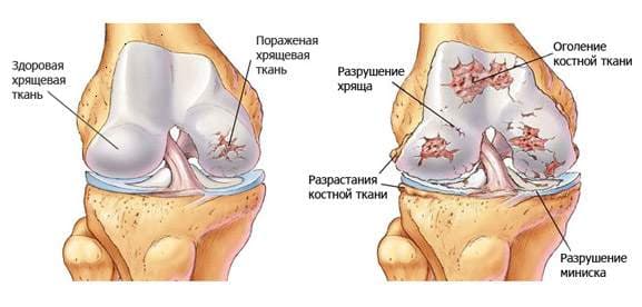 Чем лечить артроз коленного сустава
